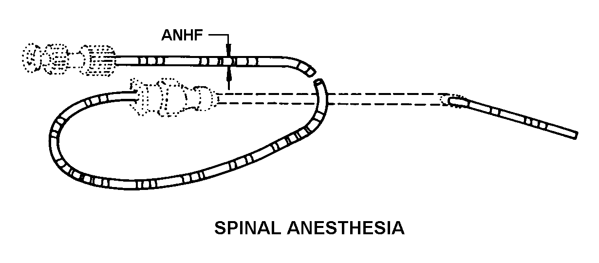 CATHETER,SPINAL ANE | 6515-00-302-5225, 003025225